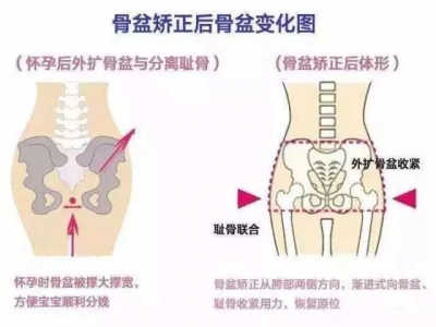 骨盆修復 真相大揭秘…… 做不做看完再決定!